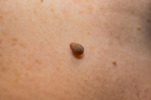 Skin tag (Papilloma)