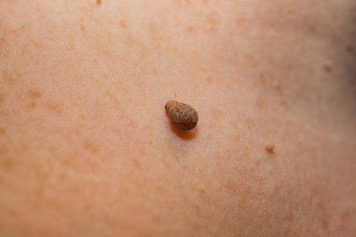 How to Remove Skin Tags (And Why You Shouldn't Do It Yourself)