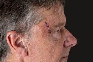 Older man with Mohs surgery wound