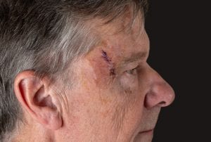 Older man with Mohs surgery wound 