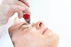 Microneedling for tear troughs