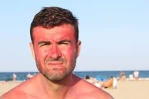 Man with sunburn on face