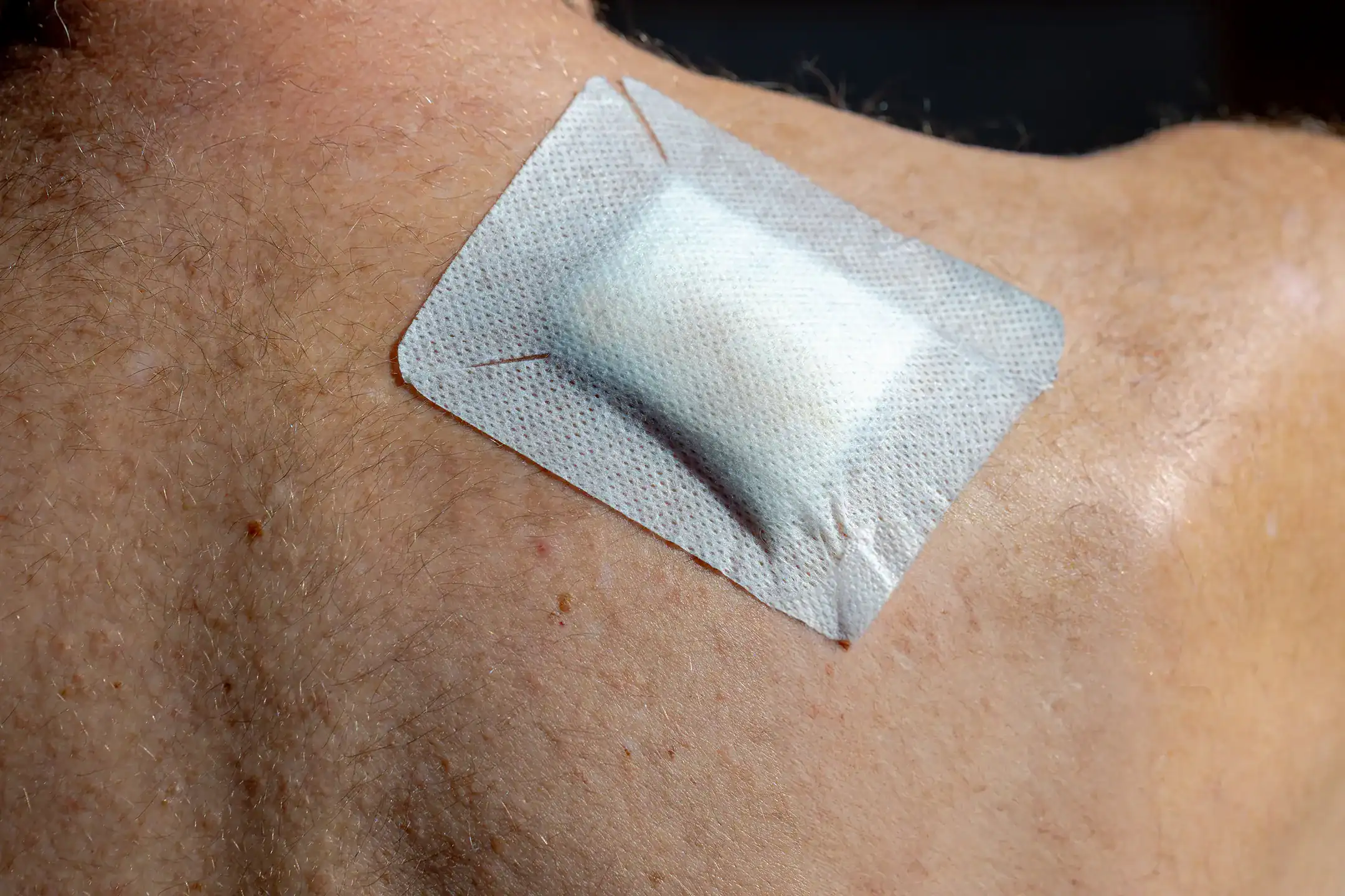 White surgical bandage on the shoulder of a Moh's surgrey patient