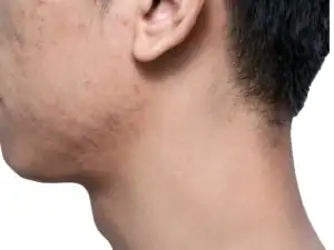 Boxcare acne scars on a young man's face