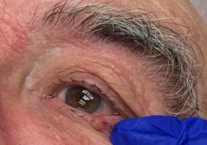 Eyelid Cancer