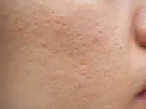 Icepick acne scars on a young man's face