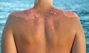 Peeling skin following a sunburn 