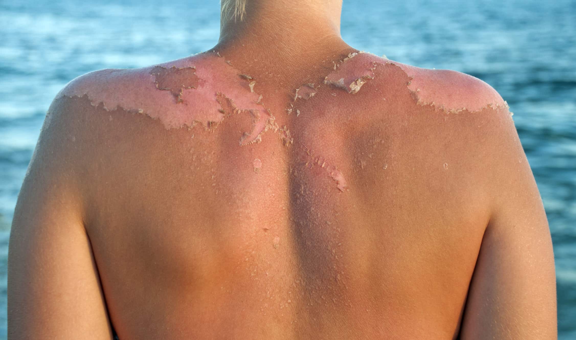 Sunburn clearance
