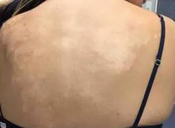 Tinea Versicolor on girls back