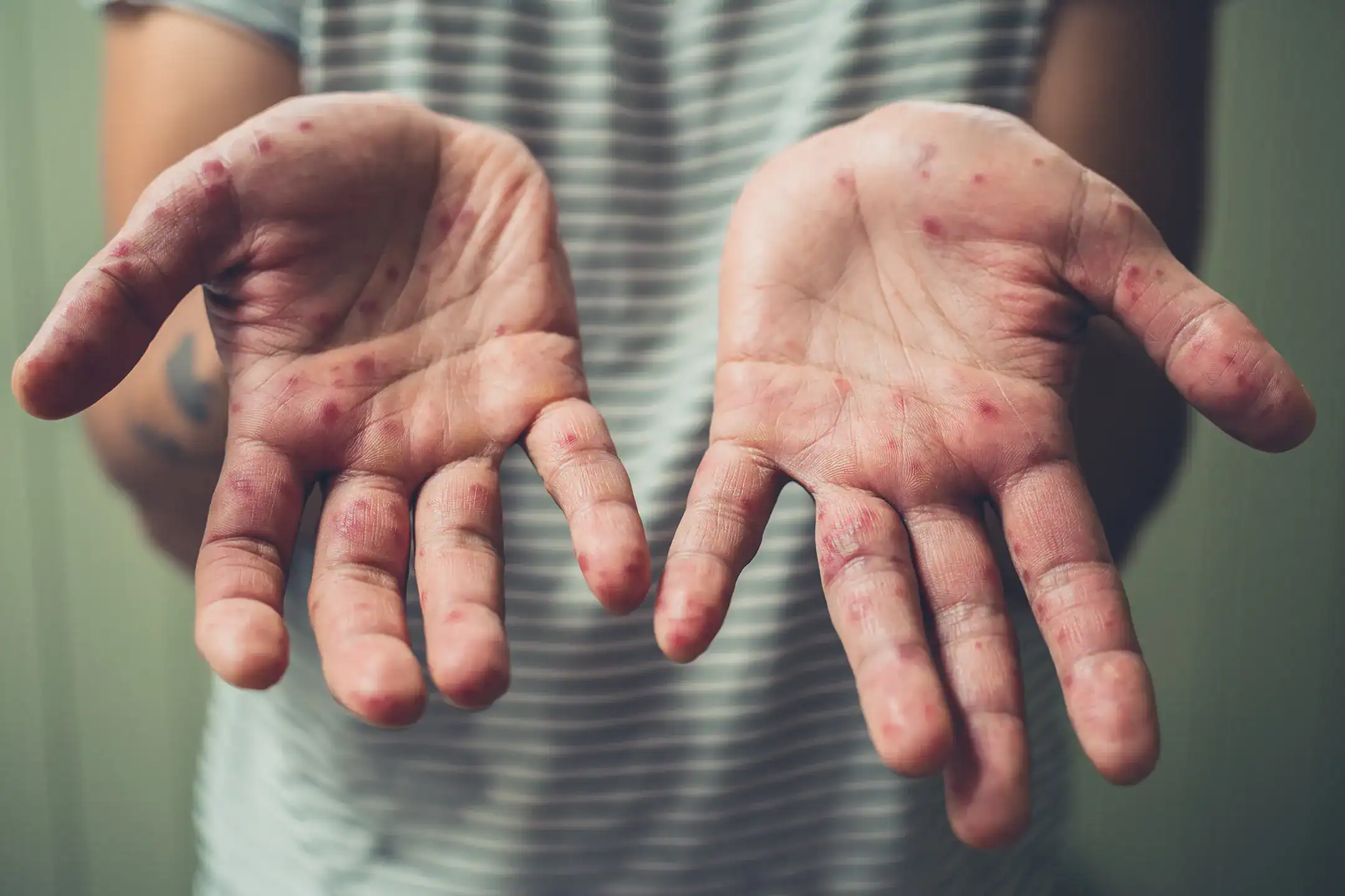 Young man shows his palms with bumps and growths that indicate hand, foot, and mouth disease