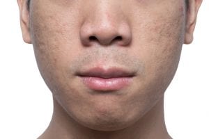 Close-up acne and scars on asian man face