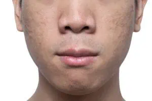 Close-up acne and scars on asian man face