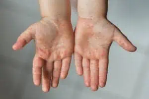 Hand, foot and mouth disease rash on hands 