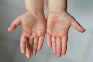 Hand, foot and mouth disease rash on hands