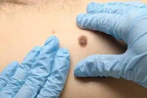 A mole is examined for skin cancer.