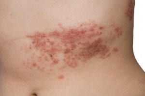 Photo of a shingles rash 