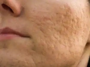 Rolling acne scars on a woman's face