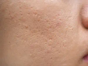 Ice pick acne scars