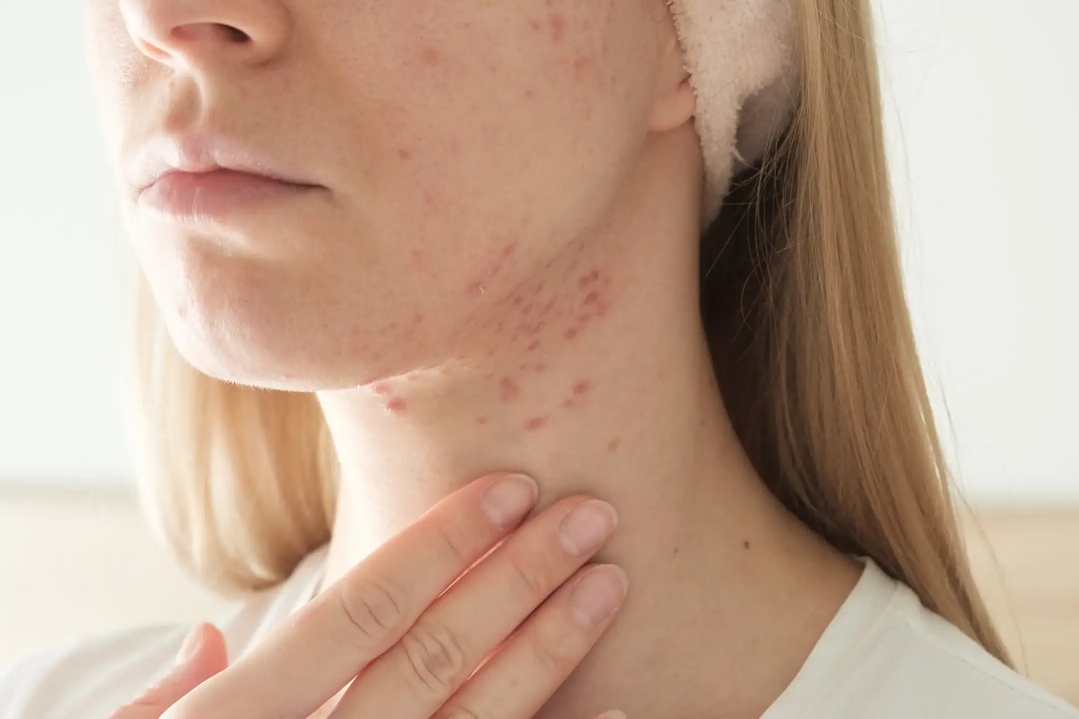 Teenage girl with cystic acne on her neck and chin
