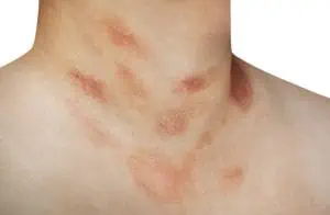 Pityriasis rosea