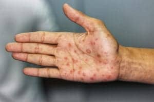 Syphilis rash on hand 