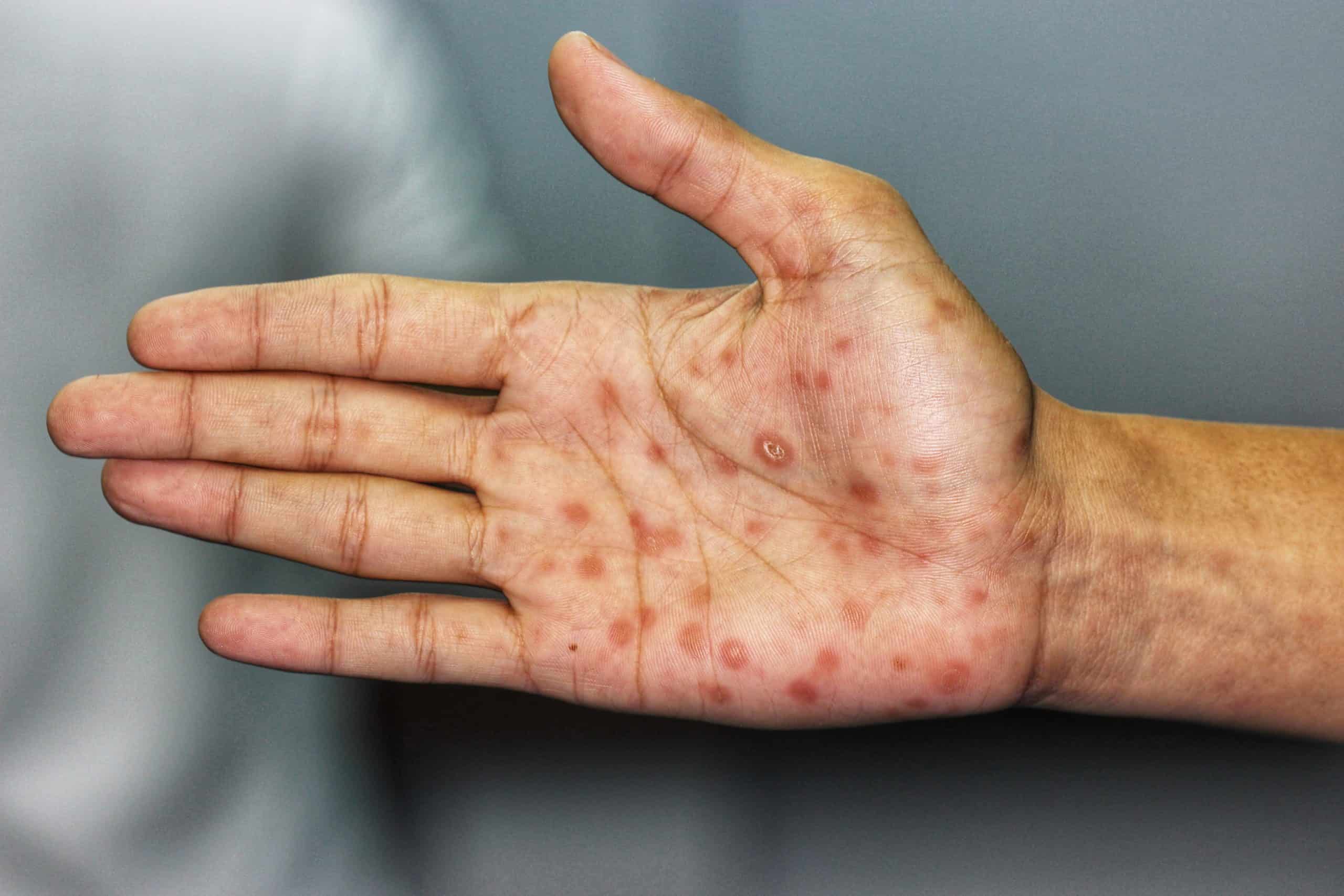 Syphilis Rash l Signs and Symptoms