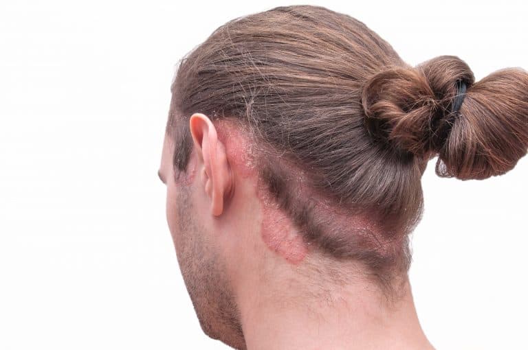 What Does Scalp Psoriasis Look Like? - Water's Edge Dermatology