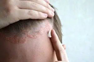 Man applying cream to scalp psoriasis on forehead.