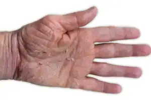 Hand eczema, also known as atopic dermatitis, with redness, itching, flaking and sometimes blisters or cracks on the hands
