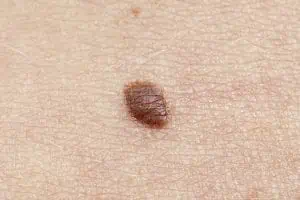 <img src="skincancer.jpg" alt="Basal cell carcinoma"/>
