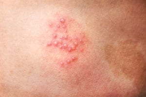 <img src="shingles.jpg" alt="Blistering shingles rash"/>