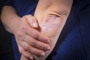 Plaque psoriasis on elbow