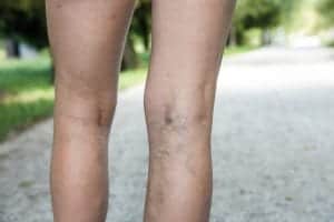 <img src="veins.jpg" alt="Woman with varicose veins on back of leg "/> 