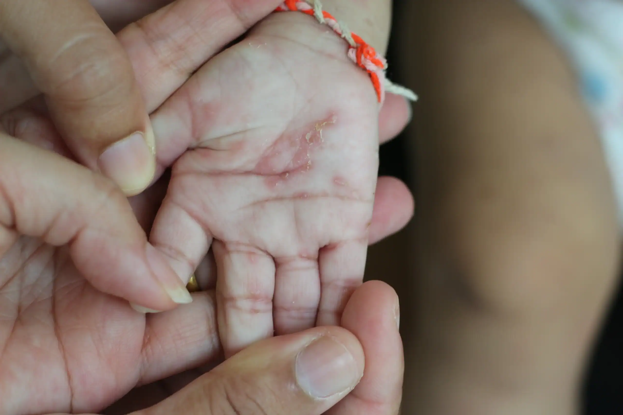 Child's hand with scabies