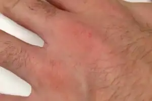 Scabies nodules on a man's hand