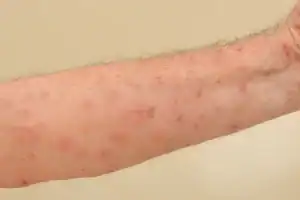 Elderly man's arm showing a scabies infestation