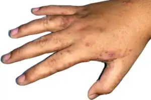 Scabies Infestation in right hand of Southeast Asian, Burmese Child in Myanmar.