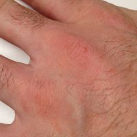 Scabies Infestation (Credit: Fhgd/Wikimedia Commons*)