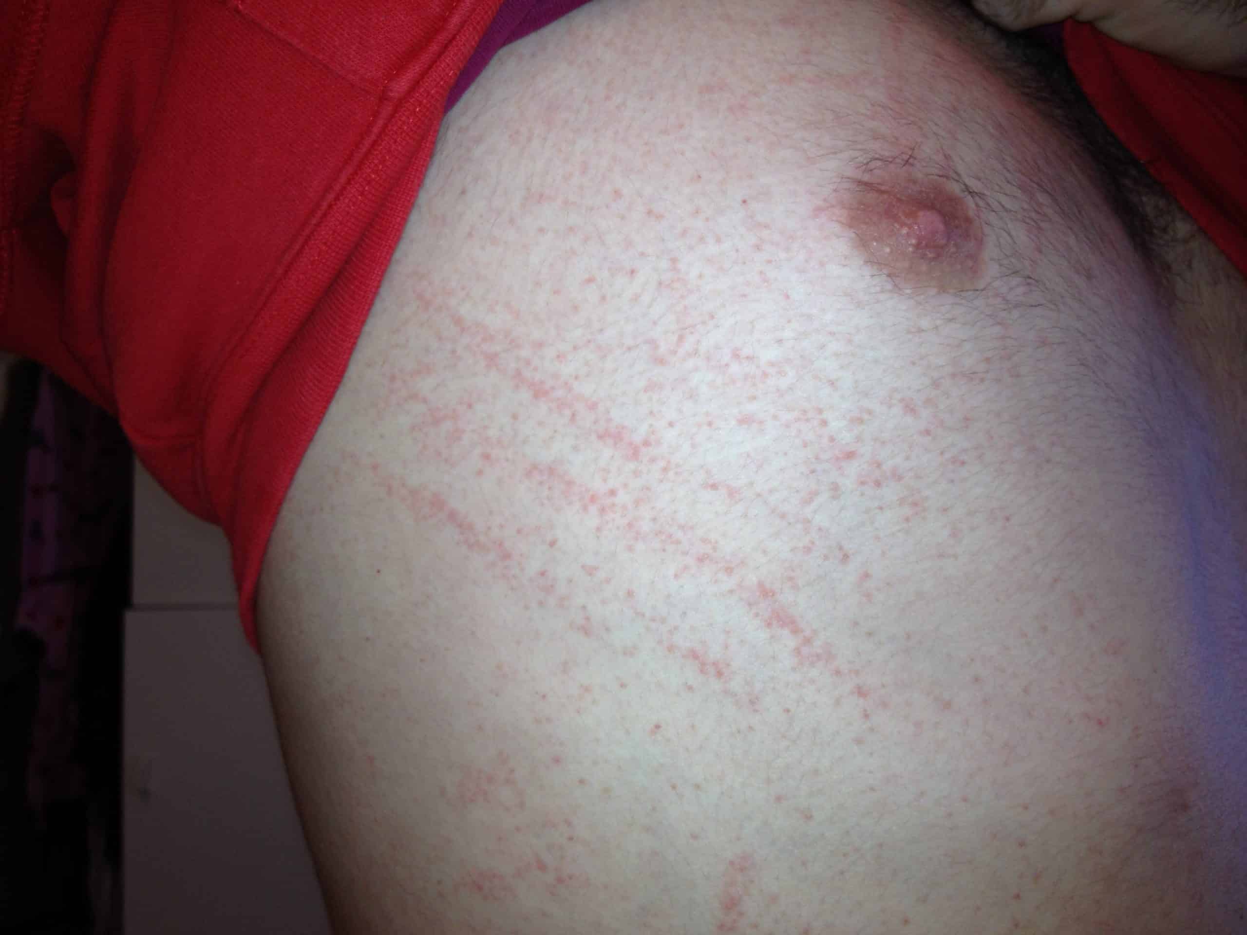 How to identify scabies atelier yuwa ciao jp