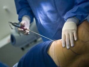 <img src="Liposuction.jpg" alt="Liposuction procedure"/> 