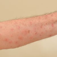 Scabies (Credit: Chuck Wagner/Shutterstock)