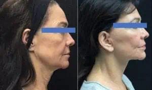 <img src="plasticsurgery.jpg" alt="Mini Neck Lift"/> 