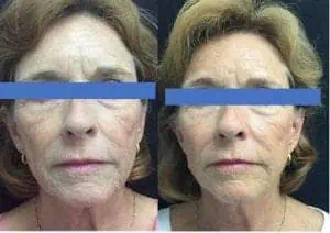 <img src="plasticsurgery.jpg" alt="Mini Neck Lift"/> 