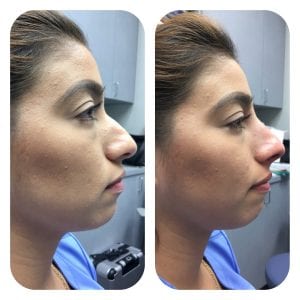 Thread Lift-Nose-Bebe-Female