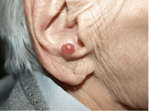 Merkel cell carcinoma