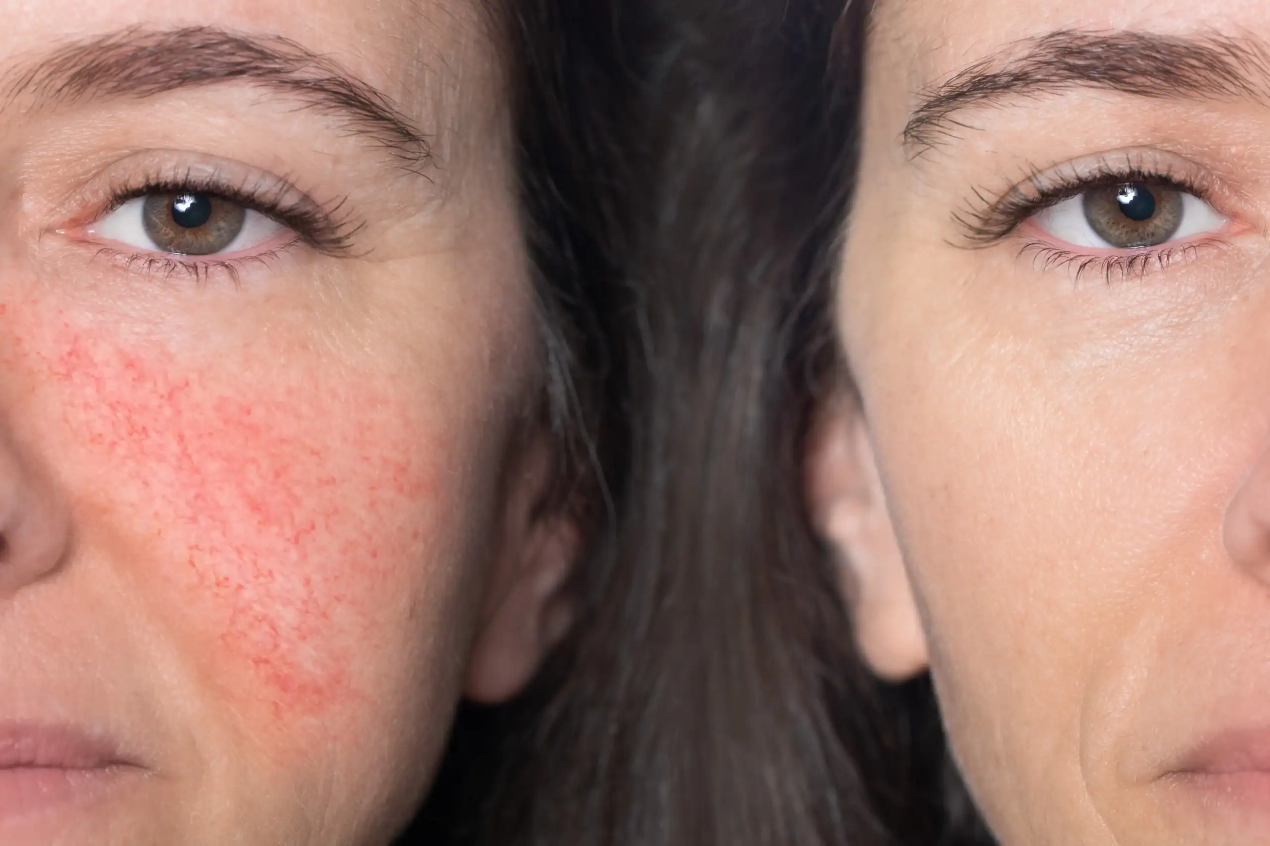Woman with rosacea shown before and after laser treatment