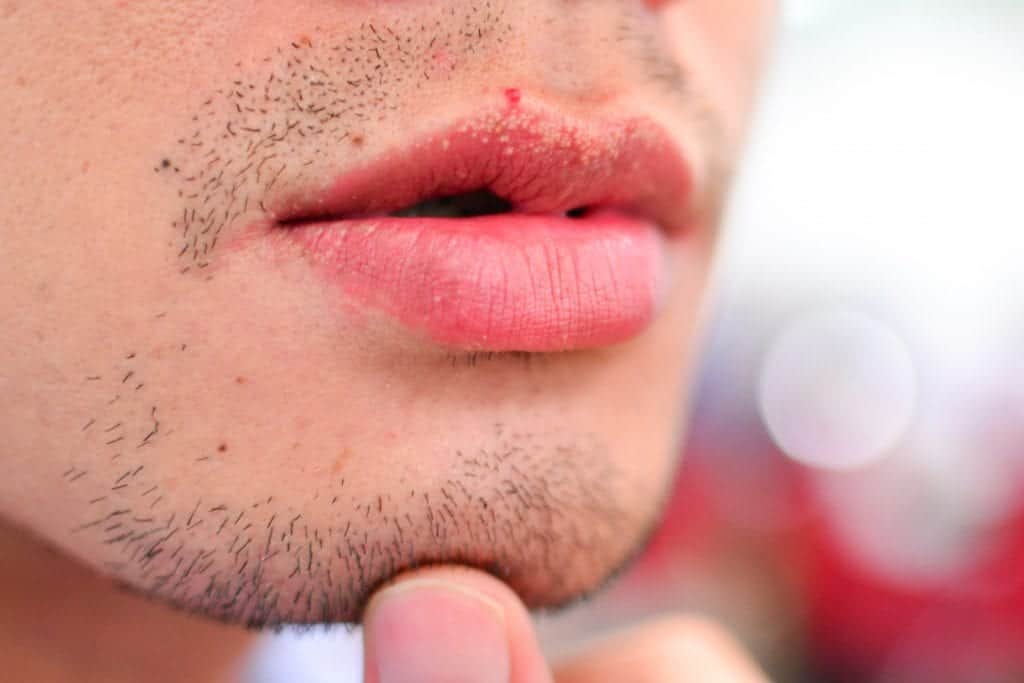 Fordyce Spots l Causes & Treatments Water's Edge Dermatology