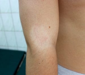 Young man with Pityriasis alba