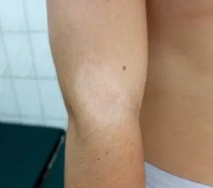 Young man with Pityriasis alba