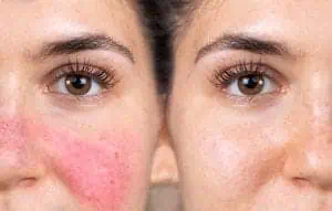 Rosacea Before-After
